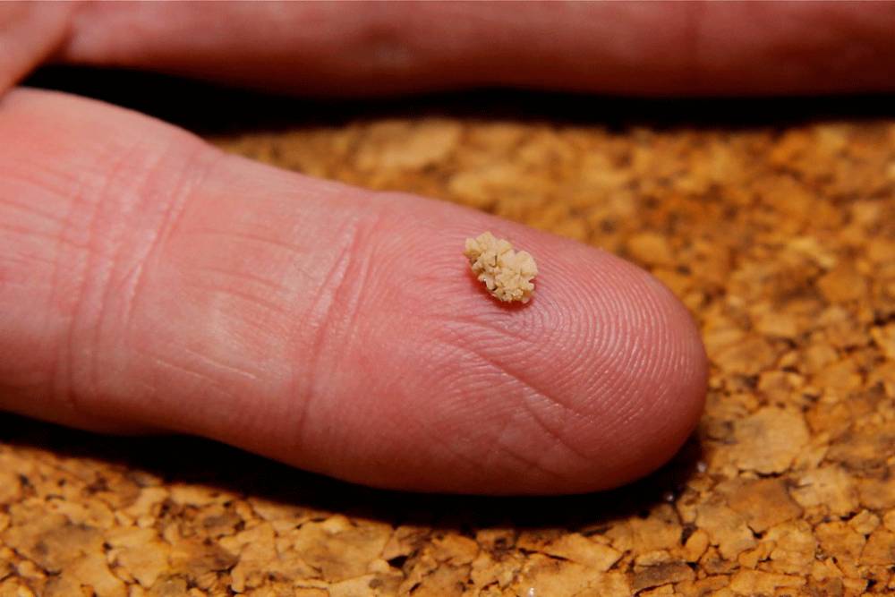 Home Remedies for Renal Calculus or Kidney Stone